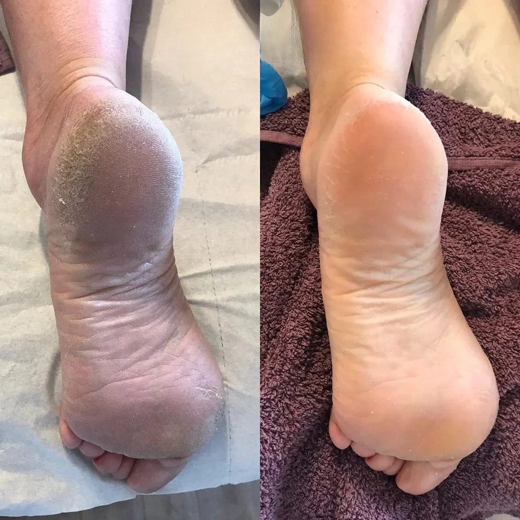 🇨🇮 FootPeel™ | Pieds Doux Comme Bébé 1