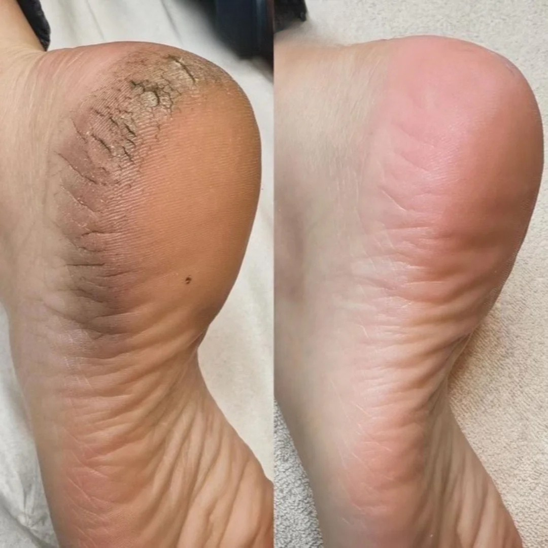 🇨🇮 FootPeel™ | Pieds Doux Comme Bébé 1