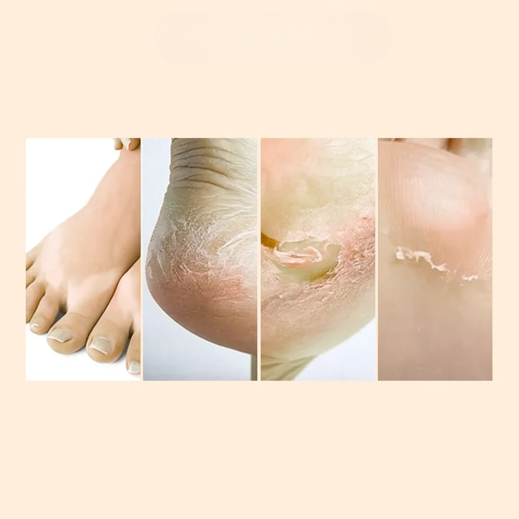 🇨🇮 FootPeel™ | Pieds Doux Comme Bébé 1