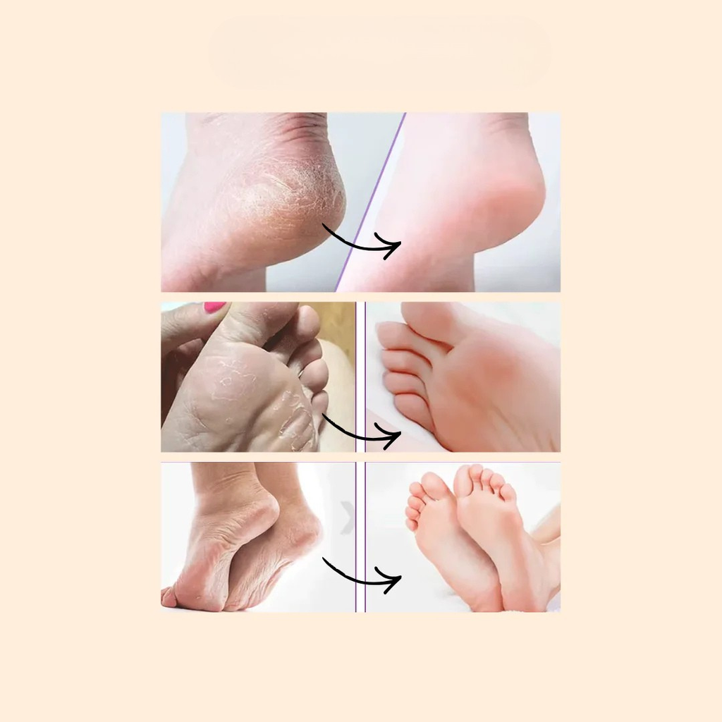 🇨🇮 FootPeel™ | Pieds Doux Comme Bébé 1